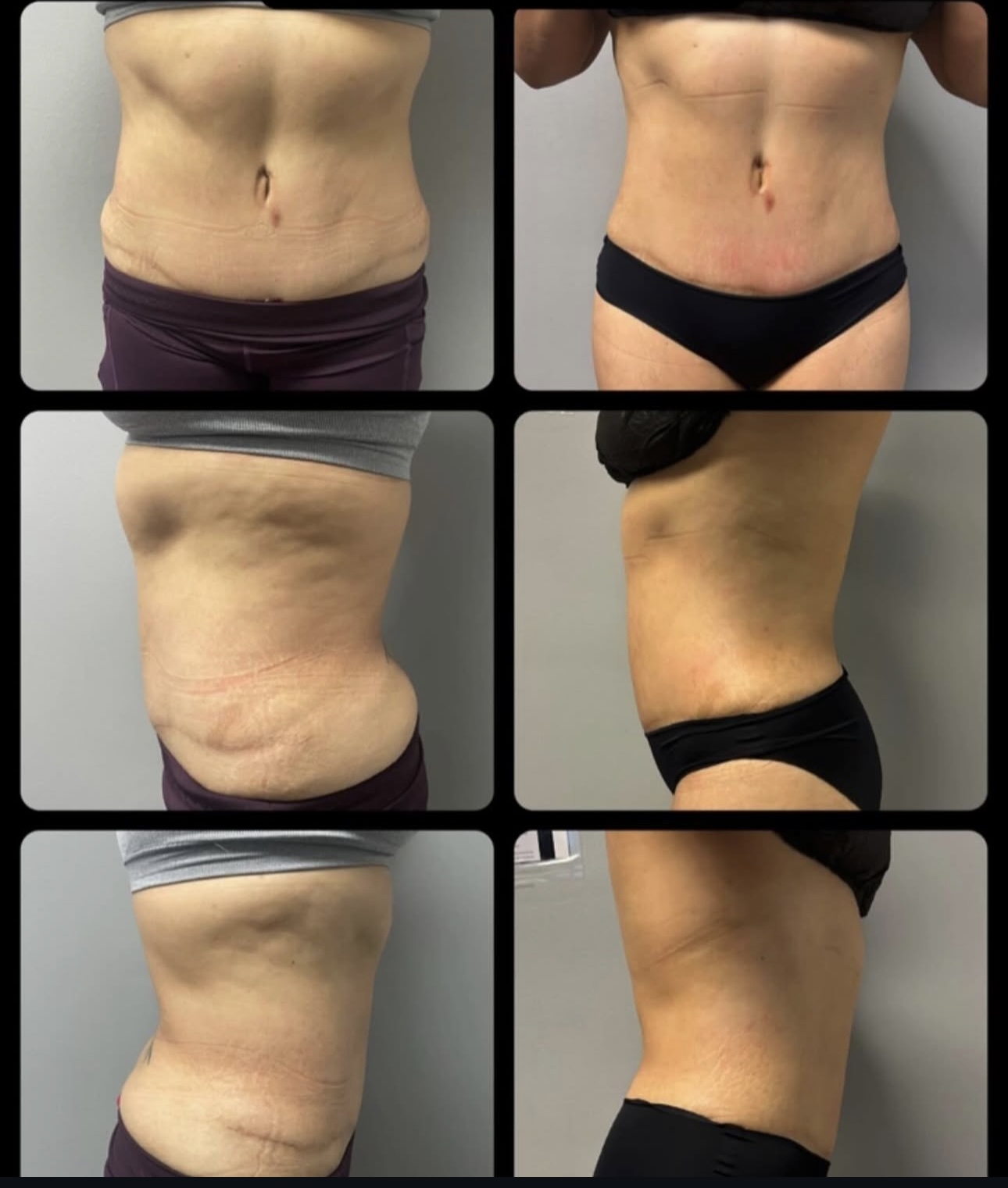 🔥 Body Contouring (Lipo Shots) transformation 1